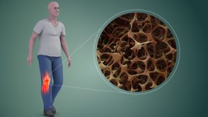 EVERYTHING YOU NEED TO KNOW ABOUT OSTEOPOROSIS