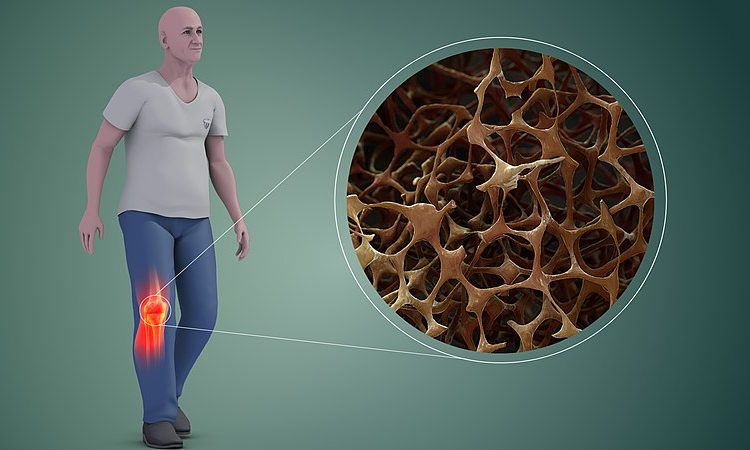  EVERYTHING YOU NEED TO KNOW ABOUT OSTEOPOROSIS