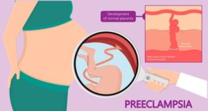 EVERYTHING YOU NEED TO KNOW ABOUT PREECLAMPSIA