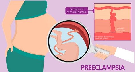 EVERYTHING YOU NEED TO KNOW ABOUT PREECLAMPSIA
