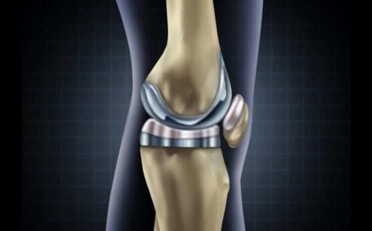 Long Life Knee Replacement: Get Rid Of Knee Problems | BMTC | Kanpur